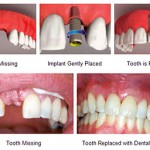 Benefits-of-Tooth-Replacement