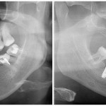 dental_implants_glasgow