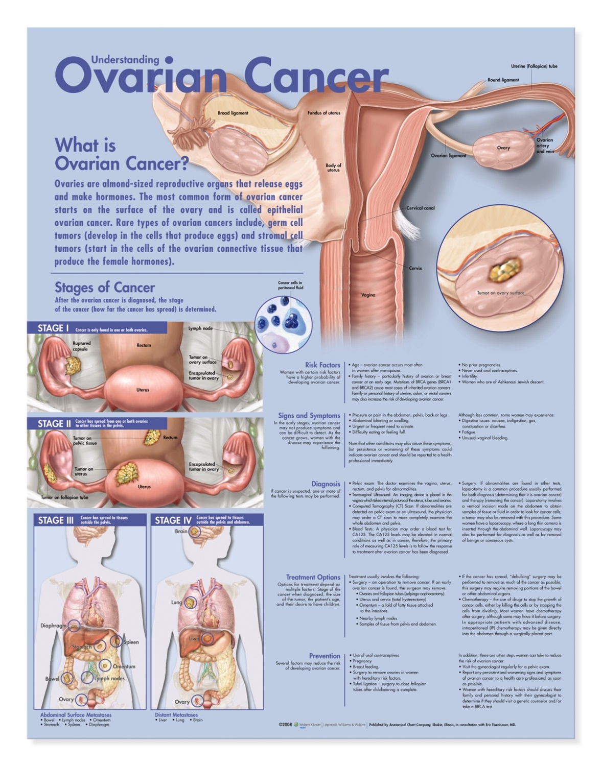 Understanding-Ovarian-Cancer