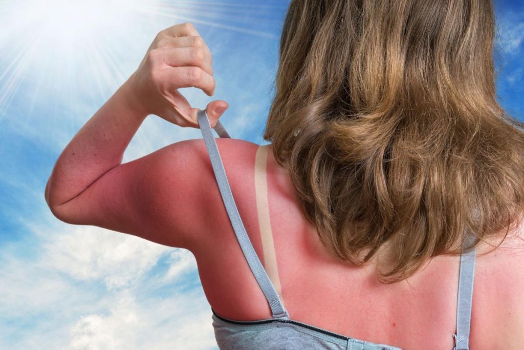 How to Take Care of After Sunburn