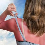 How to Take Care of After Sunburn