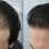 What Is Hair Transplant ? How Much Does it Cost?