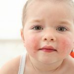 Food Allergy in Children