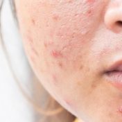 Skin Care 6 Common Acne Myths Busted