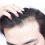 Doctor That Has Done Celebrity Hair Transplants In Los Angeles