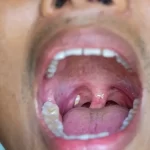 Understanding Tonsil Stones and Their Remedies