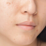 Acne spots