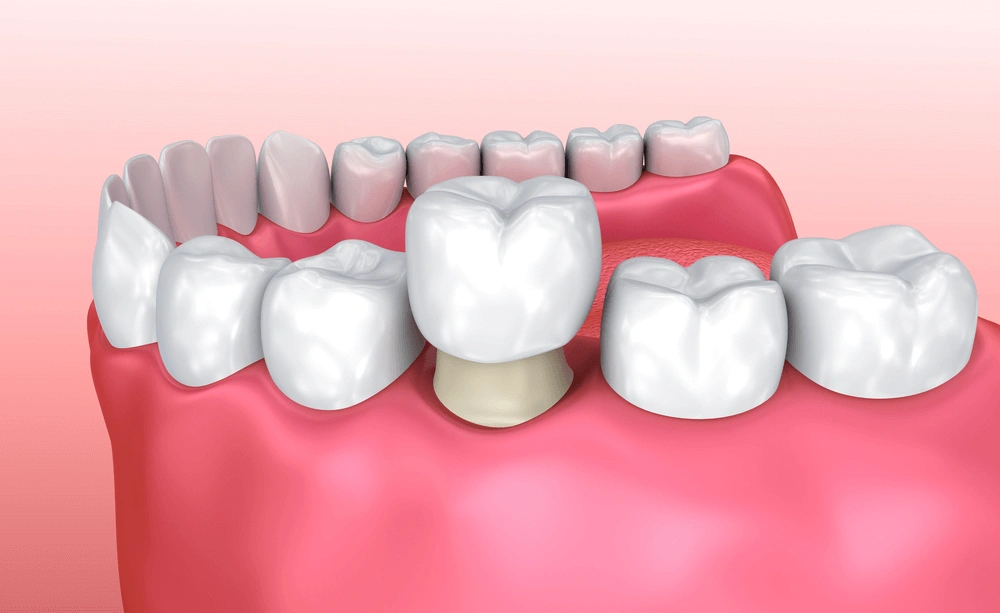 Ceramic Teeth Cap