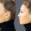 Forehead Reduction Surgery: What to Expect from Hairline Lowering