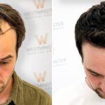 Hair Transplant London