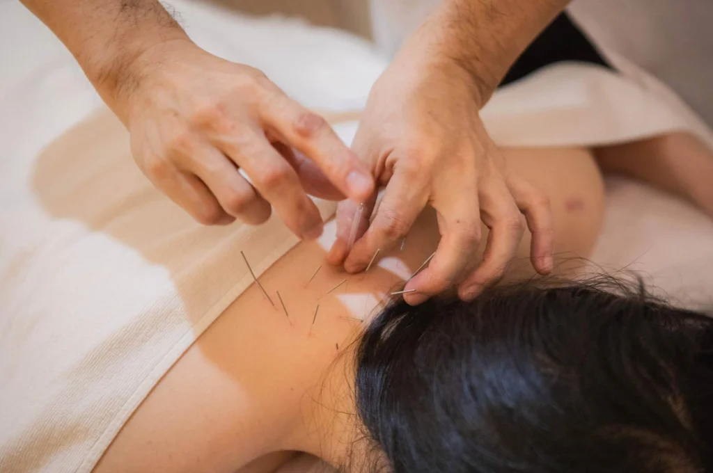 tcm acupuncture Singapore tcm acupuncture Singapore